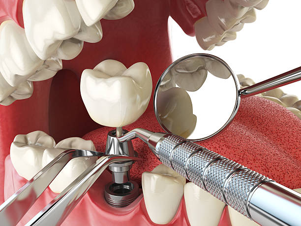 Best Emergency Denture Repair in Marco Island, FL